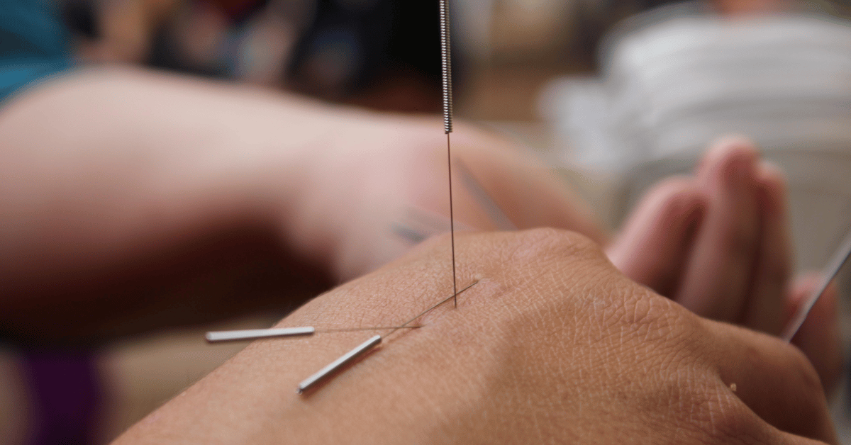 Dry Needling in Nederland: werking, klachten en voordelen